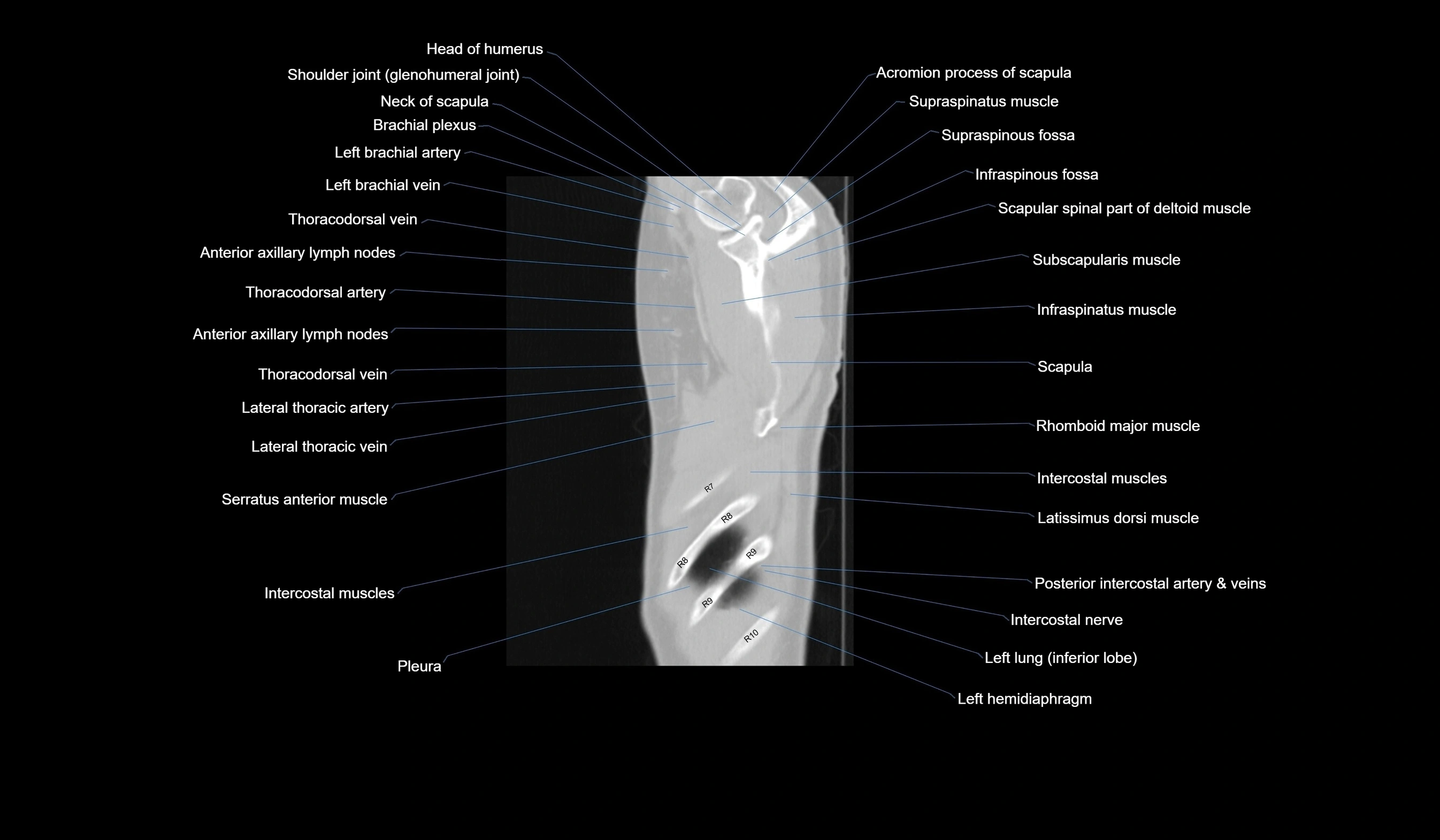 CT chest (thorax) labelled sagittal cross sectional anatomy radiology image-00134.webp